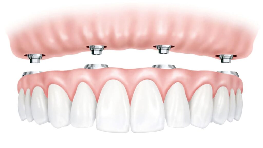 All on 4 dental implants 1