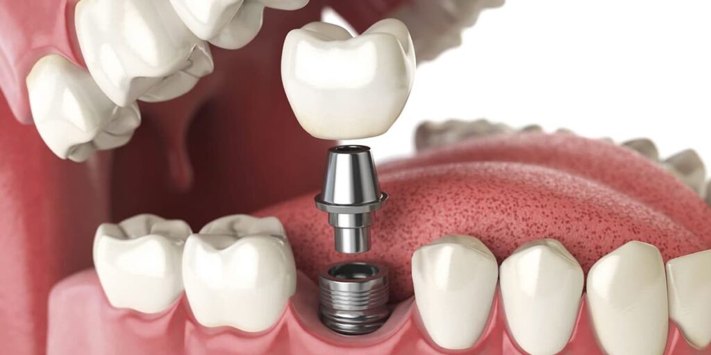 dental implants 1200px 1A 1